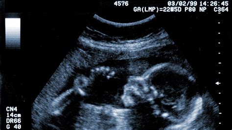 how accurate is ultrasound dating at 20 weeks